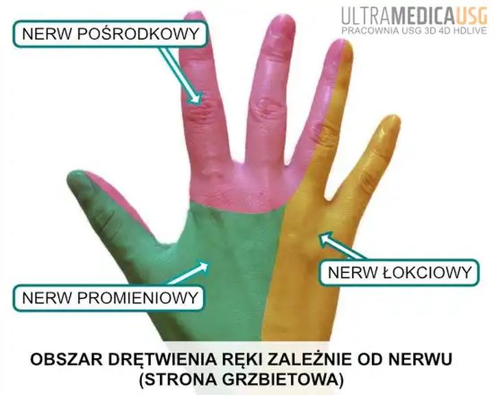 Przyczyny drętwienia kończyn