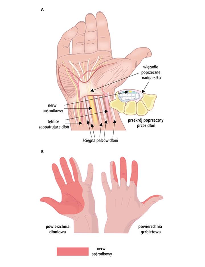 Leczenie zachowawcze i chirurgiczne cieśni nadgarstka