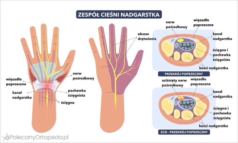 Leczenie zespołu cieśni nadgarstka