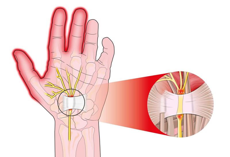 Rehabilitacja po leczeniu zespołu cieśni nadgarstka